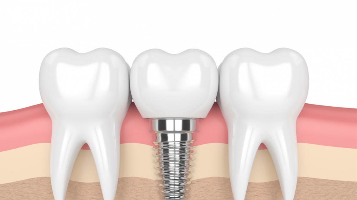 Implants Crowns & Dentures